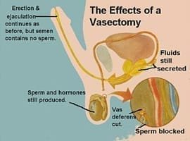 vasectomy-private-man-expat